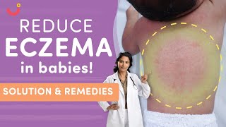 Eczema in Babies Causes Symptoms and Natural Treatment  Infant Eczema Home Remedies [upl. by Chute]