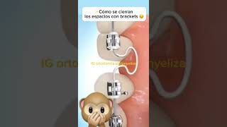 T loop orthodontics ортодонтия kieferorthopädie विषमदंत ortodonzia orthodontie orthodontie [upl. by Lorrimer]