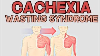 Cachexia  Wasting Syndrome  Explained [upl. by Thorbert]