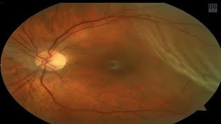 Retinal Detachment or Not [upl. by Ihp]