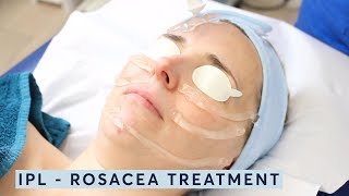 How to treat rosacea  IPL [upl. by Laitselec]