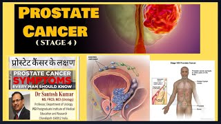 Prostate Cancer Stage 4 Prostate Cancer Metastatic Prostate Cancer DrProfSantosh Kumar PGI [upl. by Yrakcaz]