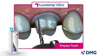 Luxatemp Ultra Rated 1 in Flexural Strength [upl. by Oad]