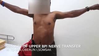 Results of Upper BPI nerve transfers [upl. by Oys77]