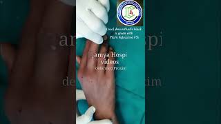 Fracture Proximal phalanx middle finger  Finger Deformity correction  Adamya Hospital Videos [upl. by Annaitat]