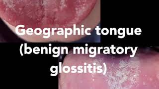 Geographic tongue Also called benign migratory glossitis [upl. by Mccomb]