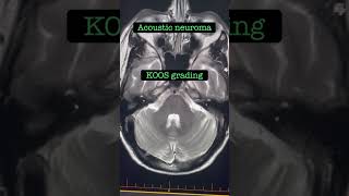 Acoustic neuroma MRI IAMs radiology [upl. by Duffie]