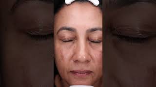 A demonstration of the mesoestetic® mesopeel® melanostop tran3x with Luxe Skin Aesthetics UnboxMe [upl. by Nancee]