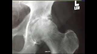 Diagnosing an Arthritic Hip Joint [upl. by Jennee]