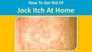 How To Get Rid Of Jock Itch At Home With Apple Cider Vinegar amp Baking Soda [upl. by Coke]