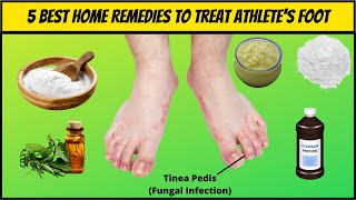 5 Best Natural Home Remedies For Athletes Foot  How To Get Rid of Athletes Foot Home Remedies [upl. by Costin]