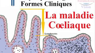 Maladie coeliaque physiopathologie et les Causes des Symptomes [upl. by Anaoy438]