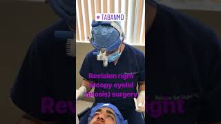 Revision on Droopy Right Eyelid Ptosis Surgery [upl. by Alliuqet]