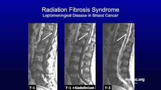 Cancers Commonly Associated with Radiation Fibrosis Syndrome  Memorial Sloan Kettering [upl. by Riamu409]