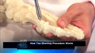 How ToeShortening Surgery Works Medical Course [upl. by Derwin]