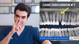 Case Discussion 7  Immediate Implant amp Bone Grafting [upl. by Ardnuahsal]