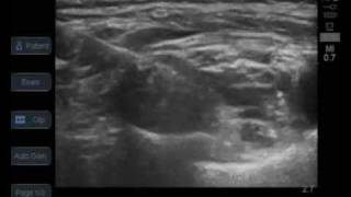 ultrasound guided supraclavicular brachial plexus block [upl. by Jean-Claude814]