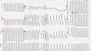 WPW syndrome Preexcites AF CS diverticulum related accessory pathway RF ablation epicardial [upl. by Asyen]