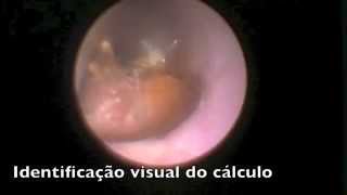 Ureterolitotripsia Endoscópica a Laser [upl. by Bartlet825]