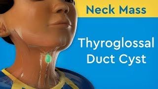 Neck Mass Thyroglossal Duct Cyst [upl. by Dibb]