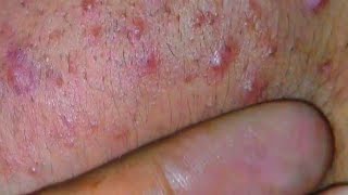 sac be spa blackheads elderly 445  sac be spa boy age blackheads new  sac be spa face information [upl. by Nnyllatsyrc]