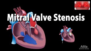 Mitral Valve Stenosis Animation [upl. by Kleiman]