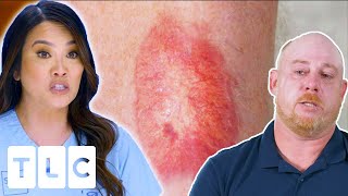 Unknown Red Patch On Man’s Leg Gets A Diagnosis After 12 Years  Dr Pimple Popper This Is Zit [upl. by Nalyak]