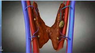 Subperiosteal Bone Resorption [upl. by Akiehsat]