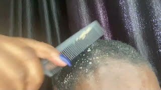 ASMR dandruff scratching on real person with comb [upl. by Tammy251]