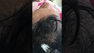 Tratamiento para la calvicie  Alopecia Cali Colombia  Parte 1 [upl. by Harrat679]