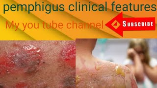 skin disease clinical features of Pemphigus disorder [upl. by Ojyma]