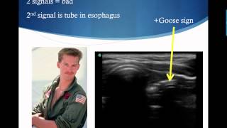 Confirming Endotracheal Tube Placement with Ultrasound [upl. by Petronia]