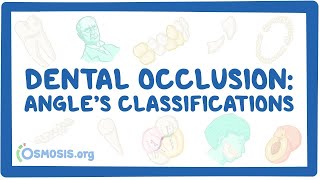 Dental occlusion  Angle’s classifications [upl. by Aiva]