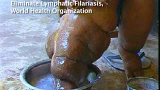 Elephantiasis Afflicts 120 Million in Africa Asia [upl. by Rentschler]