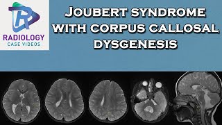 Joubert syndrome with corpus callosal dysgenesis [upl. by Ralip]