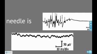 EMG and Action Potentials [upl. by Tuttle336]