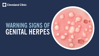 5 Warning Signs of Genital Herpes [upl. by Ilenay419]