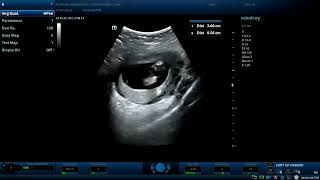 bicornuate gravid uterus 12wks pregnant woman Diagnostic ultrasound cases [upl. by Johna334]