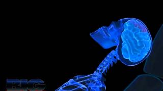 Whiplash Injury Animation Adobe Flash HD [upl. by Eirac]