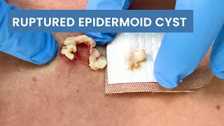 Removing a Ruptured Epidermoid Cyst  CONTOUR DERMATOLOGY [upl. by Socha632]