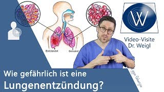 Lungenentzündung Wie gefährlich ist die Pneumonie Hygiene amp Prophylaxe sowie Symptome amp Therapie❗ [upl. by Hortensia689]