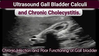 Ultrasound Gall bladder Chronic Cholecystitis and Calculi [upl. by Lucania]