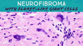 Neurofibroma with floret cells dermpath pathology dermatology [upl. by Kere40]