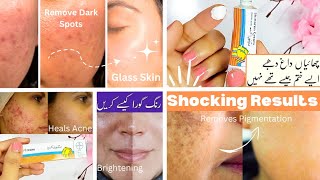 Skin Whitening Cream✨ How I Reduce my acne amp Pigmentation with Azelaic Acid Skinoren Cream 20 [upl. by Adnoek]