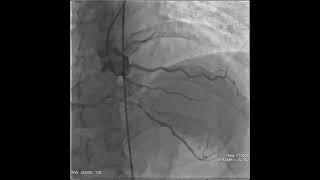 Coronary angiogram shows a large dominant right coronary artery [upl. by Naol]