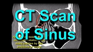 How To Read CT Sinus Scans Like An Expert [upl. by Judy576]