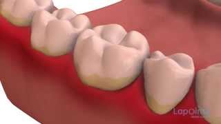 Dental plaque  Lapointe dental centres [upl. by Maison642]