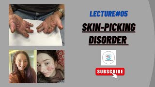 what is excoriation disorder  Dermatillomania Skin picking disorder in Urdu by Areej Awan [upl. by Euqininod]