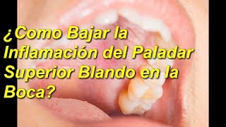 5 😮REMEDIOS NATURALES  Para El 😃PALADAR SUPERIOR BLANDO👀 [upl. by Ynaffets988]