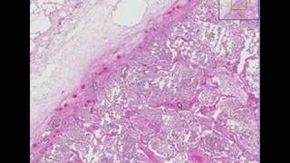 Histopathology Lung Lobar pneumonia [upl. by Saire]